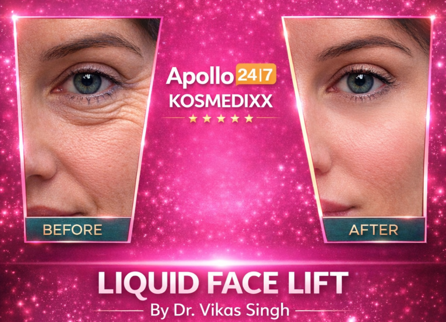 Liquid Face Lift