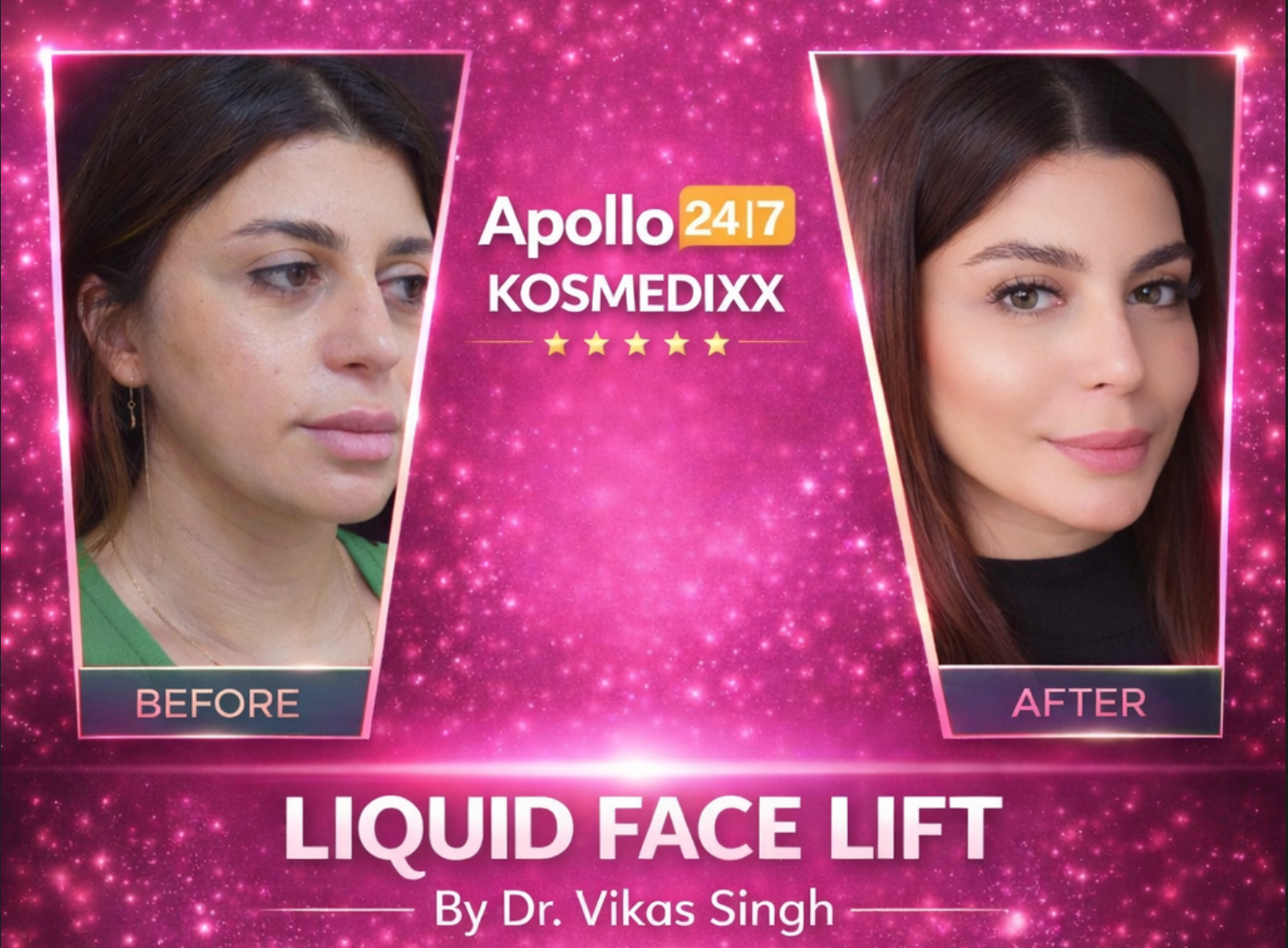 Liquid Face Lift