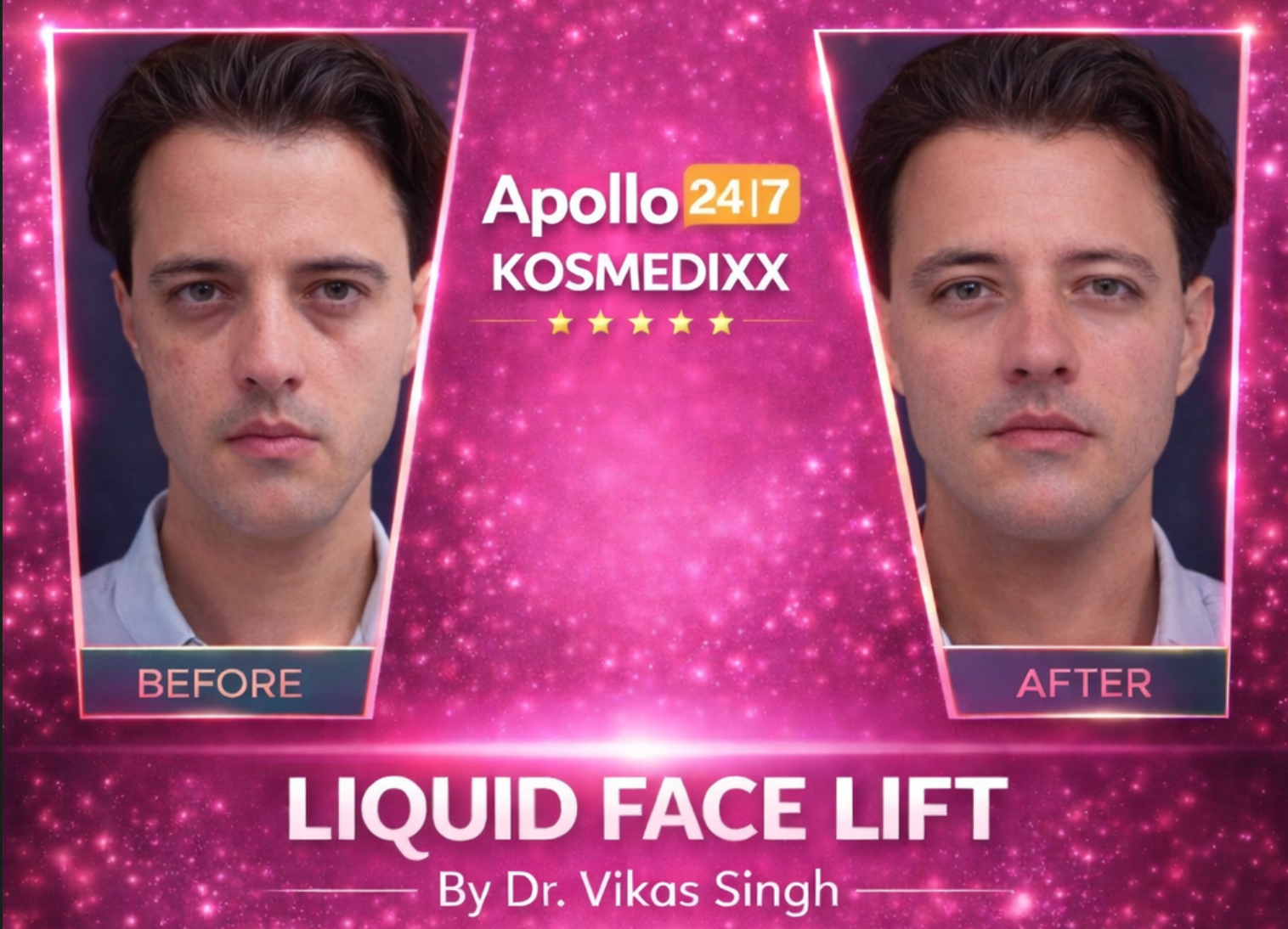 Liquid Face Lift