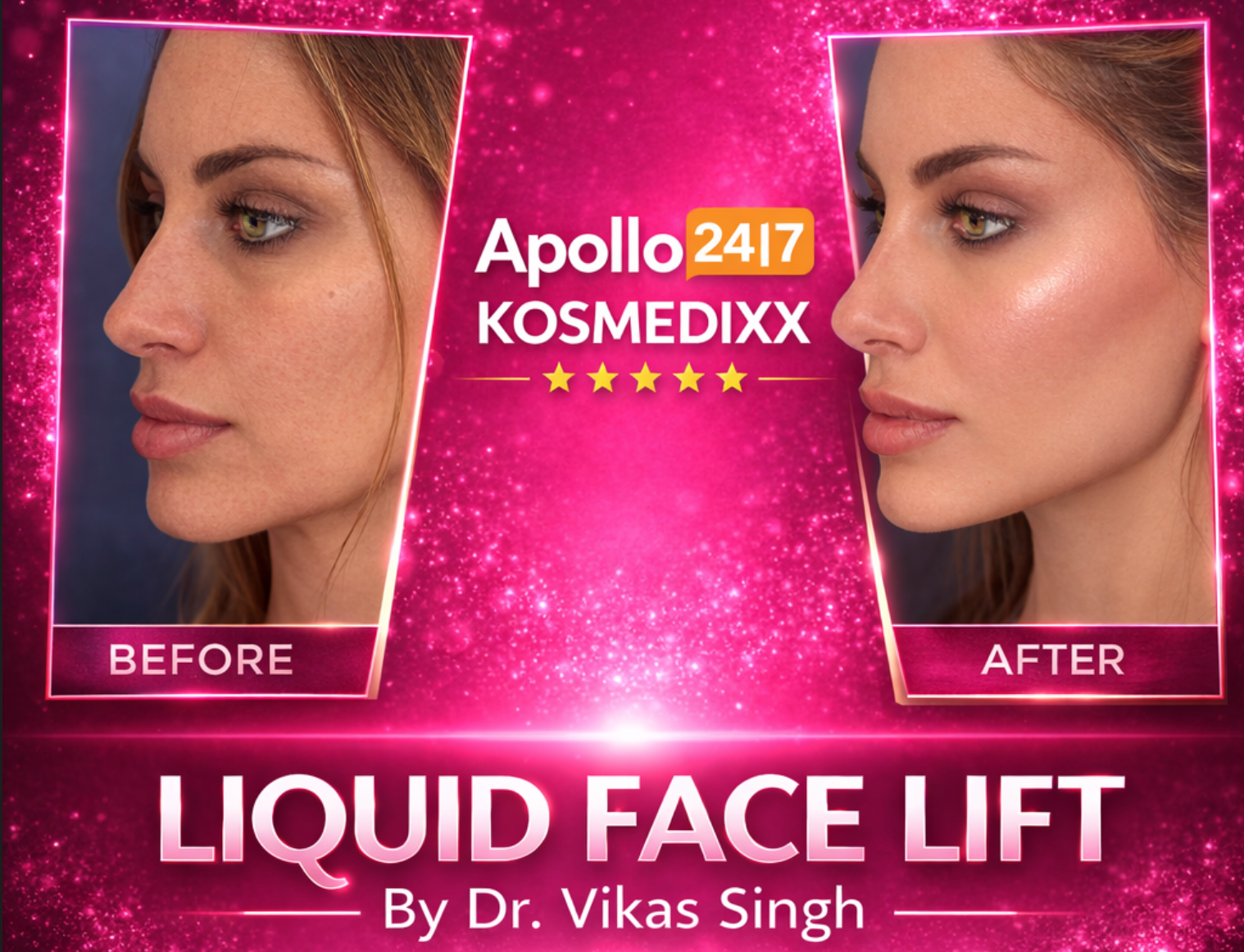 Liquid Face Lift