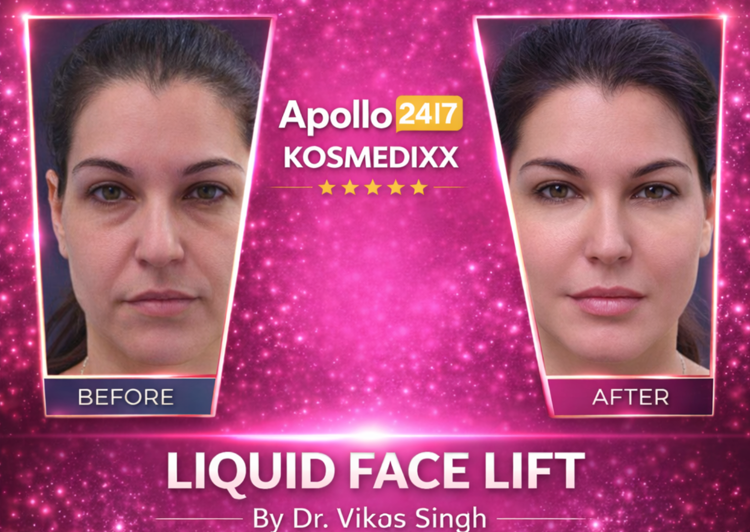Liquid Face Lift
