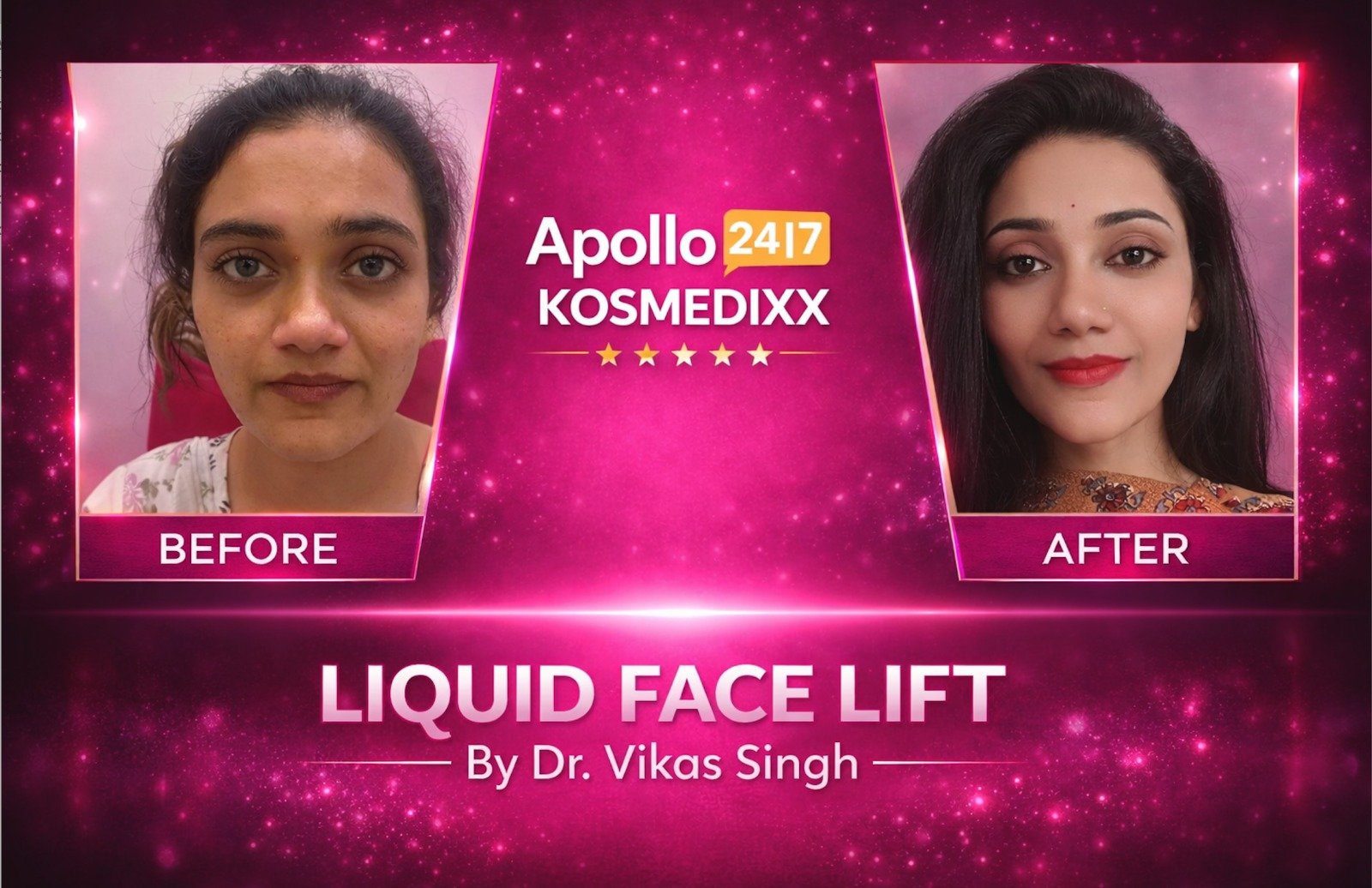 Liquid Face Lift